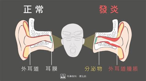 耳骨發炎肉粒|耳朵痛又癢，關於急性外耳炎您該知道的事 